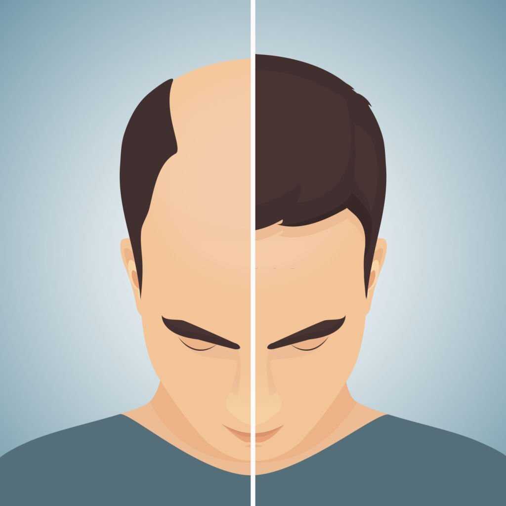 Hair Transplant Fethiye