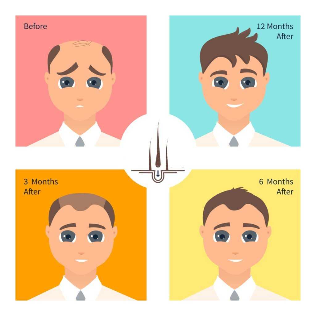 Hair Transplant Fethiye