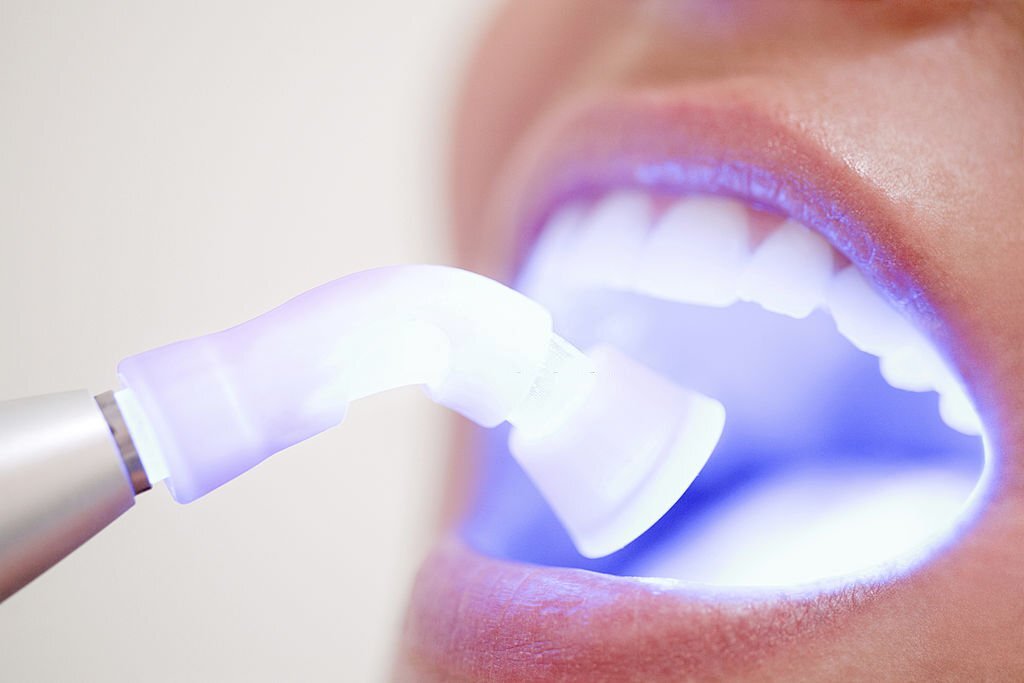 Laser Teeth Whitening Fethiye