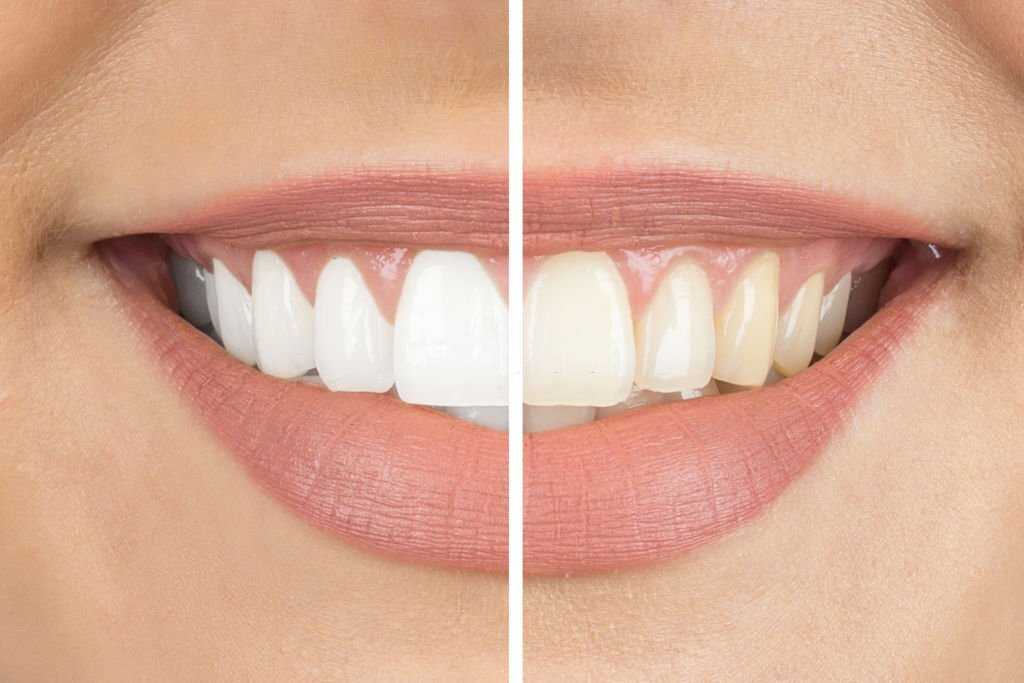 Teeth Whitening Fethiye