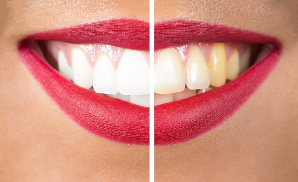 Teeth Whitening Fethiye