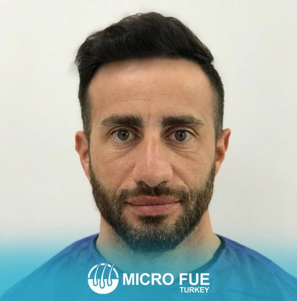 Hair Transplant Fethiye