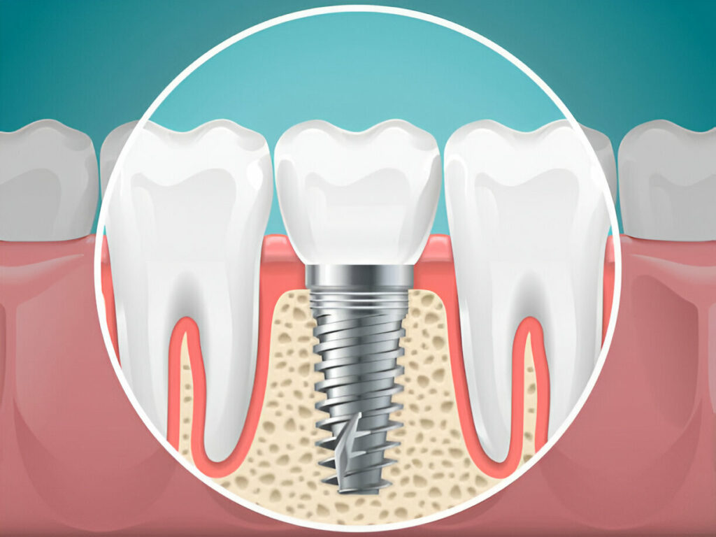 Dental Implants in Fethiye Turkey