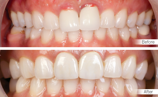 Zirconia Crown in Fethiye Turkey