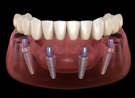 All-on-4 Dental Implants for the Top Jaw in Fethiye
