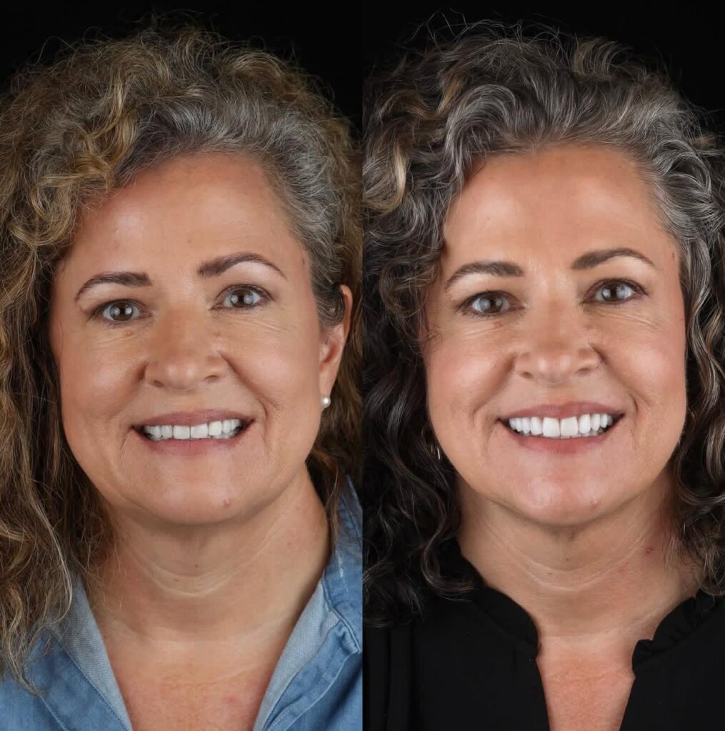 Dental Treatments Fethiye Prices 2026