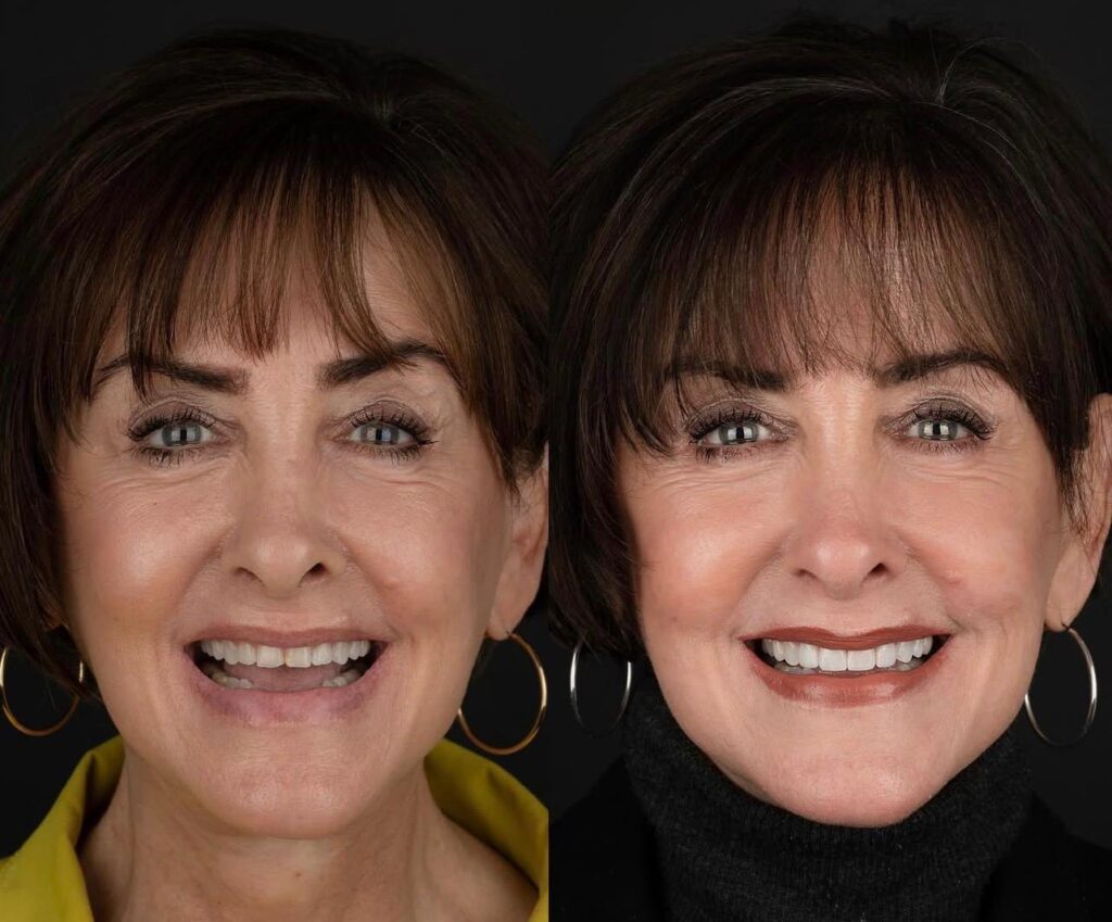 20 Emax Veneers in Fethiye 