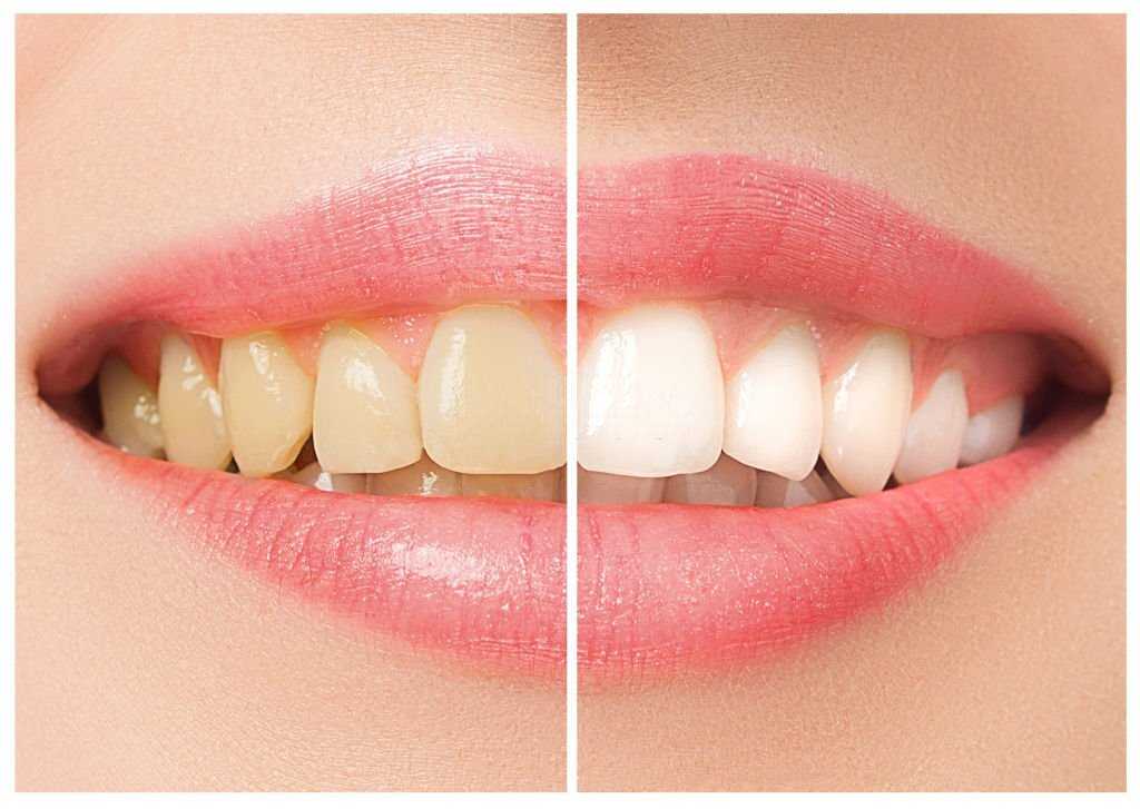 Teeth Whitening Fethiye