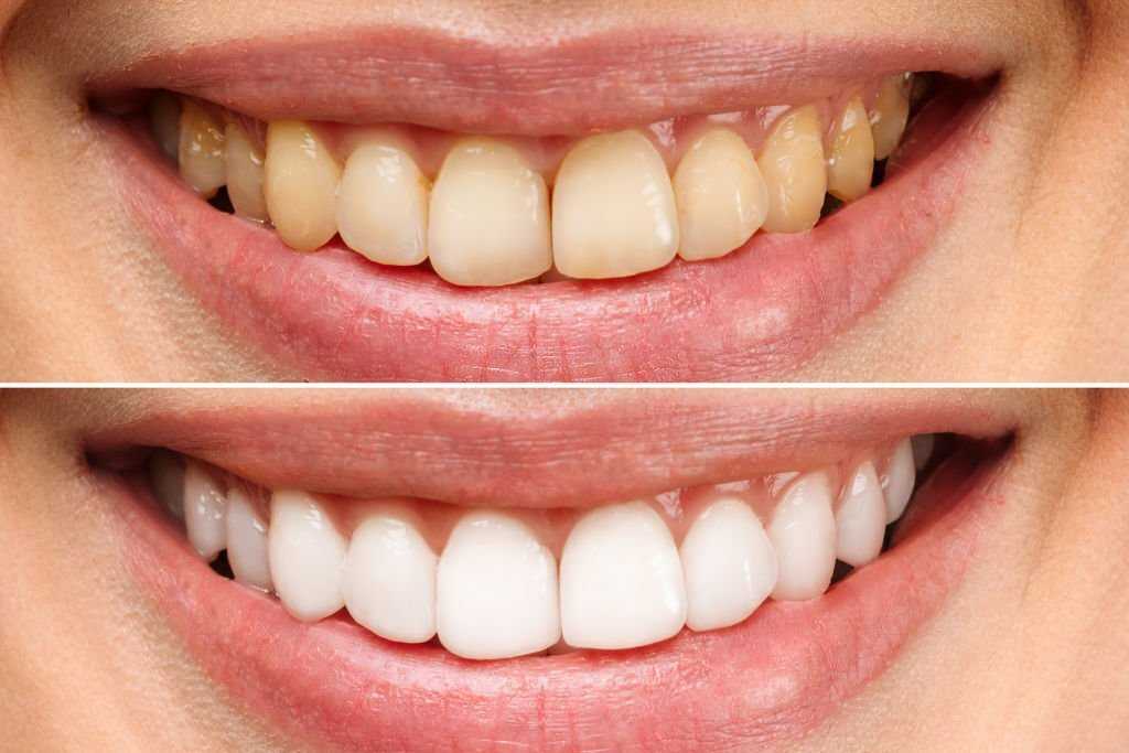 Teeth Whitening Fethiye