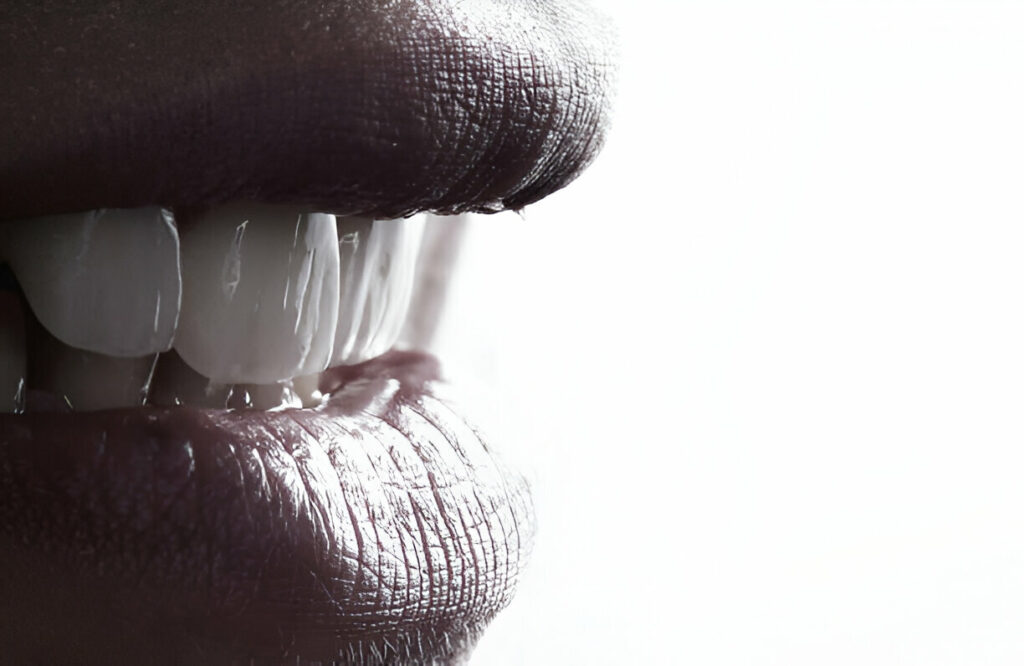 Emax Crown in Fethiye Turkey