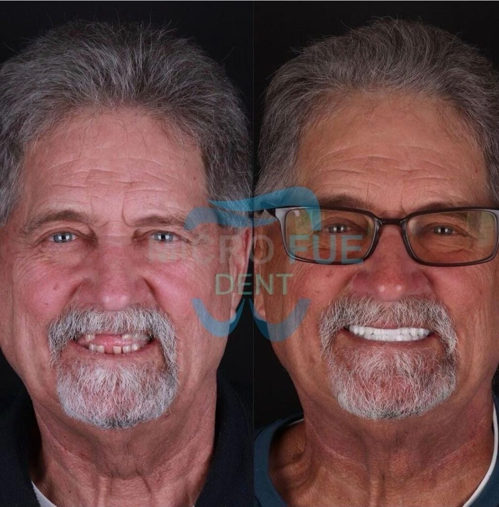 All-on-4 Dental Implants for the Top Jaw in Fethiye