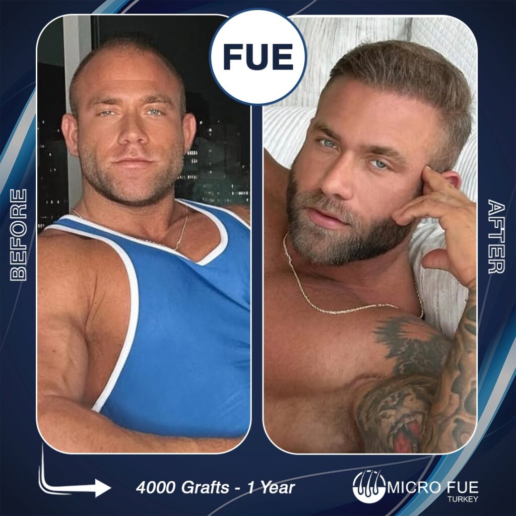 Hair Transplant in Fethiye