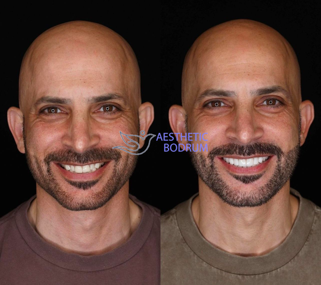 All-on-4 Dental Implants for the Top Jaw in Fethiye