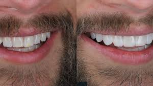Laminate Veneers in Fethiye